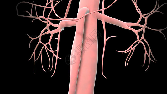 腹部动脉动脉瘤形成药品插图器官心血管外科主动脉帮助病人作品动脉瘤图片