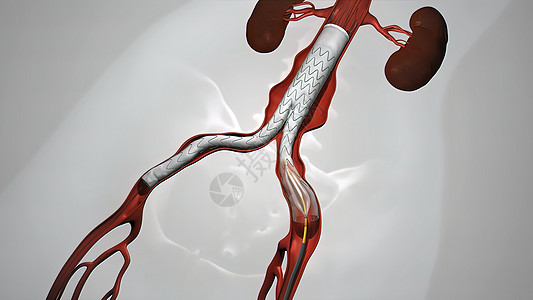 静脉有螺纹的气球血管成形程序主动脉动脉渲染金属支架屏幕疾病镜头心脏病学外科图片