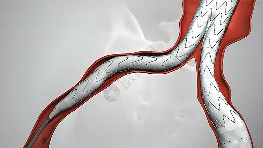 静脉有螺纹的气球血管成形程序镜头流动心脏病学治疗手术动脉主动脉动脉硬化管子心血管图片