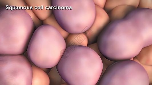 癌症细胞的分裂和生长生活组织癌细胞细胞学染色质间期遗传活检疾病病理图片