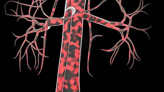 3D 脉搏剖腹膜动脉瘤医学插图糖尿病身体粗肠肋骨胰岛素消化冒号介词大肠糖病图片