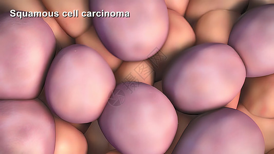 尿路上皮癌癌症细胞的分裂和生长文化生物学冒号显微镜间期细胞学遗传癌细胞染色质病理背景