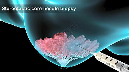 具有乳腺病理学的  女孩  女性人的结构说明和缝合细菌化疗生物防御癌症宏观疾病胸部技术生物学图片