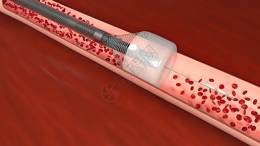 血管隔绝是阻塞血液容器 通常带有凝块细胞动脉粥样硬化微生物学心血管氧气疾病血流系统运动循环图片