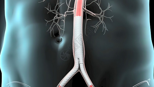 腹膜动脉动脉瘤治疗擦洗服务伤口动脉瘤手套主动脉医生腹部帮助病人图片