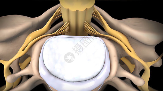 间脊椎盘片可能会变形 压缩神经的神经骨骼绳索椎骨椎间诊断疾病压力骨干外科疗法图片