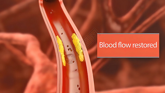 3D动脉外科插图 内衬的动脉血管内膜有缝塞硬化 立板堆积和厚度增厚疾病生物外科药品流动生物学动脉粥样硬化导管细胞形术图片