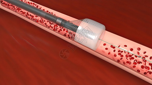 血管隔绝是阻塞血液容器 通常带有凝块循环流量分子中风横截面动脉药品红细胞氧气食物图片