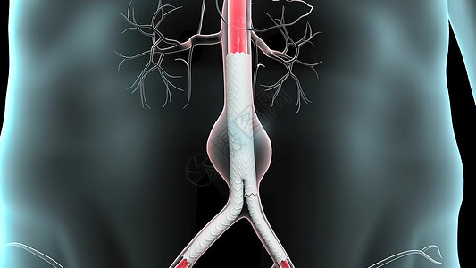 腹部动脉动脉瘤形成病人动脉心血管手术插图伤口外科主动脉疾病服务图片