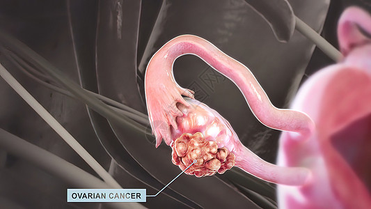 卵巢中的细胞成倍增长 并异常生长 这种疾病是脊髓癌胸部外科解剖学词云身体女士手术输卵管关心药品图片