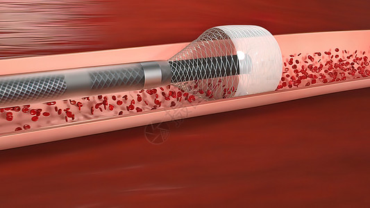 血管隔绝是阻塞血液容器 通常带有凝块心脏病学分子动脉氧气红细胞中风血流心血管原生质系统图片