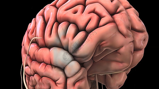 脑损伤造成脑出血 导致脑出血攻击动脉风险血管动脉硬化食物细胞器官生物学卫生图片