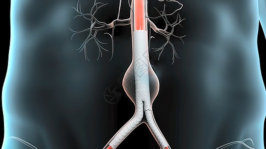 3D 脉搏剖腹膜动脉瘤医学插图身体粗肠器官杯子肋骨呼吸心碎事故糖尿病胰岛素图片