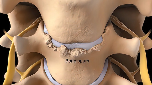 脊椎膜切除是脊椎骨间缓冲和连接组织受伤的伤痕创伤髓质疼痛插图手术骨干柱子椎间椎骨手指图片