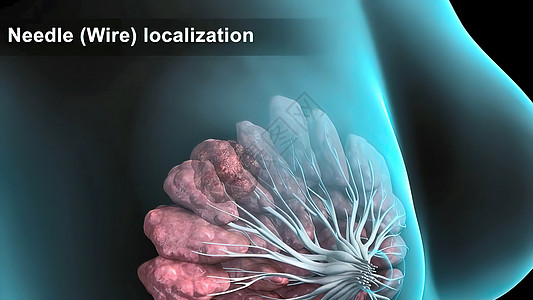 具有乳腺病理学的  女孩  女性人的结构说明和缝合防御冒号淋巴瘤化疗技术科学医生宏观生物疾病图片