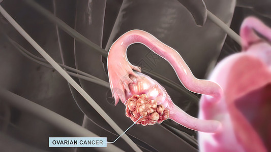 卵巢中的细胞成倍增长 并异常生长 这种疾病是脊髓癌风险手术输卵管女性保健卫生女士胸部身体子宫图片