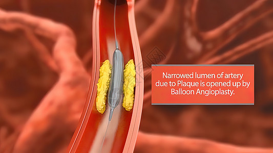 3D动脉外科插图 内衬的动脉血管内膜有缝塞硬化 立板堆积和厚度增厚心脏病学手术静脉流明药品金属疾病生物学支架生物图片