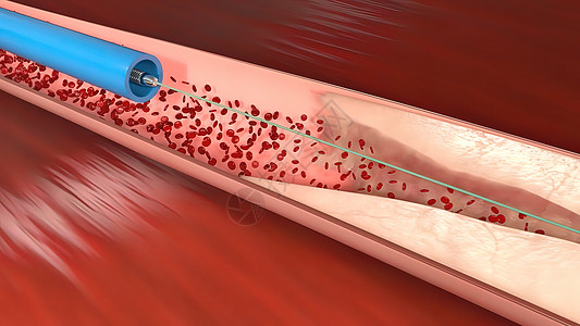 血木医疗的冠状动脉图片素材