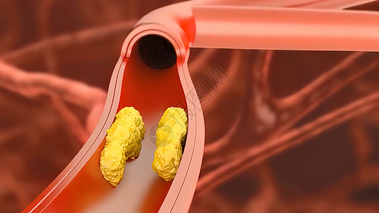3D动脉外科插图 内衬的动脉血管内膜有缝塞硬化 立板堆积和厚度增厚侵入性心脏病学生物疾病药品手术流明科学静脉管子图片