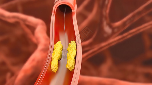 3D动脉外科插图 内衬的动脉血管内膜有缝塞硬化 立板堆积和厚度增厚科学材料治疗手术流明形术封锁生物学心脏病学疾病图片