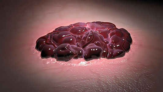 三维细胞3D医学插图 血管胎记的插图护理细胞棕色美容治疗癌症医生色素沉着风险印迹图片