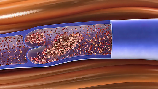 血友病 凝固和如何血液凝聚疾病循环黄疸感染细胞细胞质微生物学生物学癌症系统图片