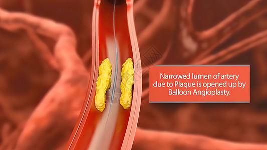 3D动脉外科插图 内衬的动脉血管内膜有缝塞硬化 立板堆积和厚度增厚科学流明支架治疗细胞瘟疫流动封锁心脏病学药品图片