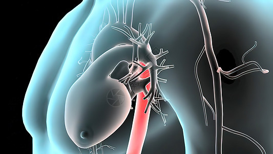 3D 脉搏剖腹膜动脉瘤医学插图器官生理腹部心碎糖尿病粗肠身体消化事故肋骨图片