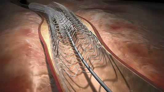 血红蛋白细胞流经阻塞的动脉 导致动脉硬化疾病医院显微镜支架手术药品攻击情况监视器医生血管图片