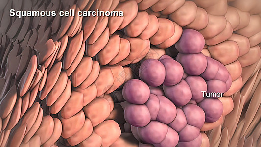 癌症细胞的分裂和生长疾病生物学病理癌细胞冒号细胞学染色体组织组织学损害图片