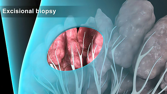 具有乳腺病理学的  女孩  女性人的结构说明和缝合辐射防御科学癌症技术化学疾病生物学细菌硬化图片