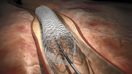 血红蛋白细胞流经阻塞的动脉 导致动脉硬化疾病攻击外科心血管医院心绞痛医生手术支架心脏病学血管图片