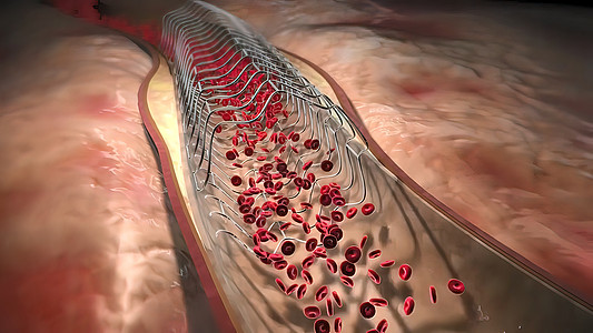 血红蛋白细胞流经阻塞的动脉 导致动脉硬化疾病情况手术心脏病学医院保健支架诊断心血管心肌监视器图片
