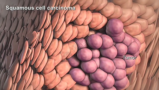尿路上皮癌癌症细胞的分裂和生长划分科学细胞学组织学病理染色体生活组织显微镜死亡背景