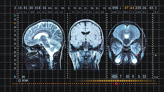 Mri扫描专业医疗设备上的脑组织图象考试电脑病人身体颅骨医院扫描器诊断形状外科图片