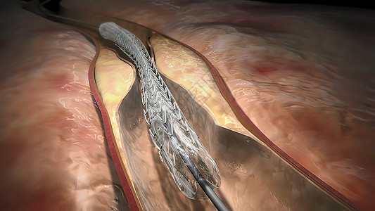 血红蛋白细胞流经阻塞的动脉 导致动脉硬化疾病医生药品血管外科监视器手术心血管心绞痛保健情况图片