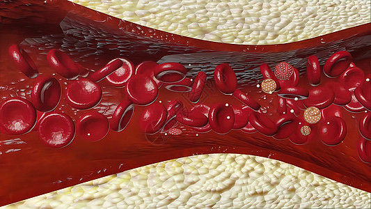 由胆固醇血液或容器内引发冠心动动脉病的板块导致的胆固醇血或镜头主动脉插图毛细管叶子管道水果渲染形成疾病图片