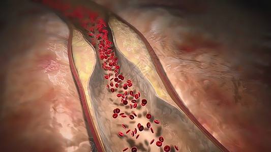 3D医疗插图 其中3D型外壳可损坏血管衬内 并造成血凝块的形成压力治疗心血管程序攻击动脉粥样硬化手术器官动脉外科图片