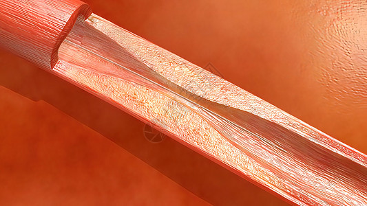 血红蛋白细胞流经阻塞的动脉 导致动脉硬化疾病支架血管外科心脏病学心血管医院情况药品攻击监视器图片