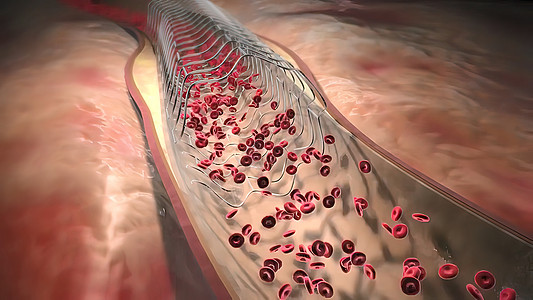 血红蛋白细胞流经阻塞的动脉 导致动脉硬化疾病监视器医生药品保健血管攻击医院心血管外科诊断图片