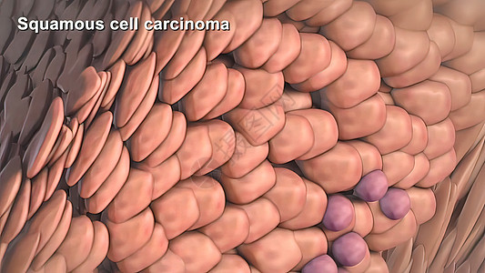 癌症细胞的分裂和生长组织学划分损害癌细胞生物学生活疾病染色体细胞学活检图片