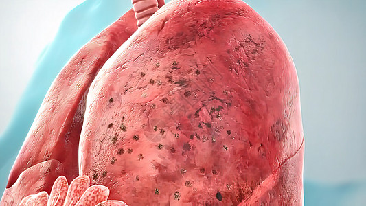 肺瘤3d导致医学解剖图片