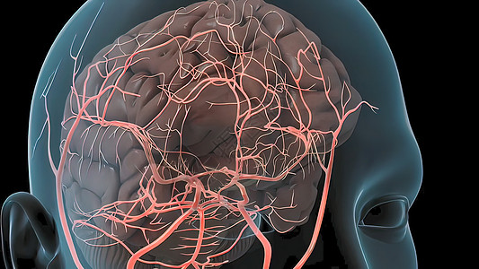 脑动脉瘤爆发导致脑细胞出血 造成脑大出血毛细管大脑系统血栓血管疾病血液障碍供应卫生图片