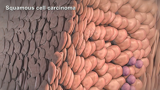 癌症细胞的分裂和生长冒号病理疾病组织显微镜活检损害细胞学遗传癌细胞图片