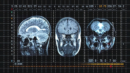 Mri扫描专业医疗设备上的脑组织图象展示身体检查断层疾病诊所考试外科癌症插图图片