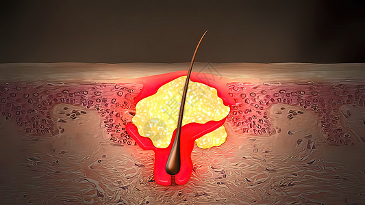 当细菌感染堵塞或封闭孔隙时 就会出现发炎性酶女士放大镜插图皮肤科青春期治疗女性女孩头发脓包图片