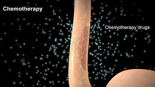 化疗应用在肿瘤地区 肿瘤被清理干净了生物学身体医学诊断细胞病人药品保健微生物学生物图片