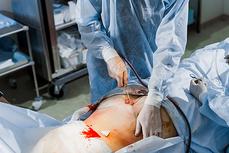 外科医生做腹膜成形塑料操作 以减少腹部和切除纤维素 矫正身体形状对皮肤进行整形化妆品诊所药品组织女士女性形术医院手术技术图片