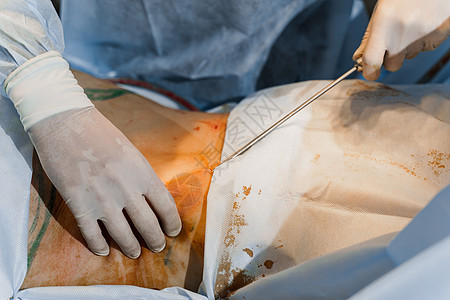 外科医生在紧闭的谷状地区除去脂肪 塑料操作 以减少腹部和去除纤维素护士工作医院手术女性女士治疗整形药品组织图片