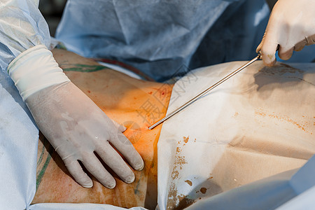 外科医生在紧闭的谷状地区除去脂肪 塑料操作 以减少腹部和去除纤维素女士手术女性病人治疗医院形术整形化妆品组织图片